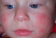 аллергия я детей на лице