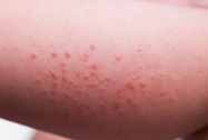 аллергические высыпания на коже руки